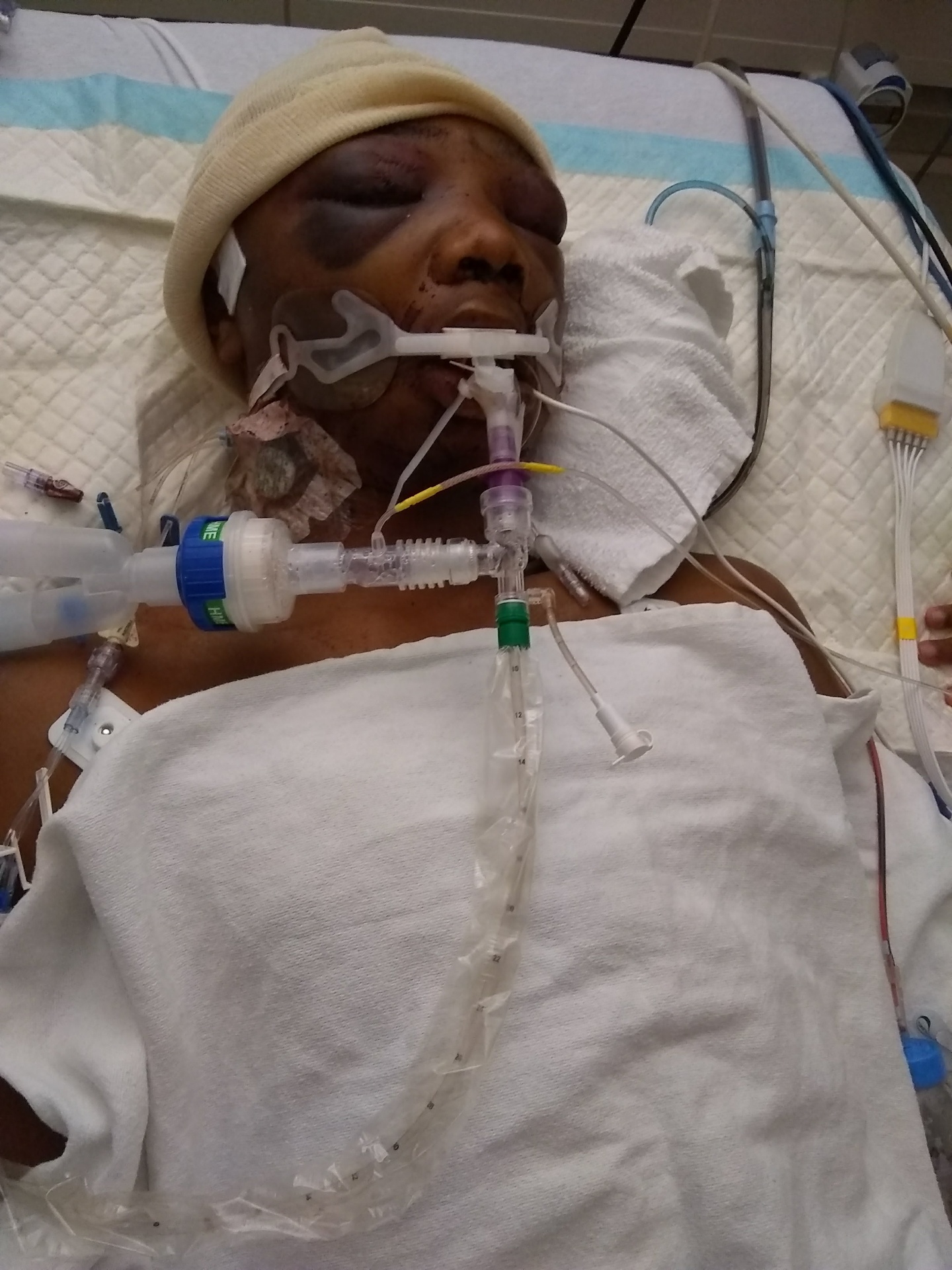Joseph in the ICU on life support