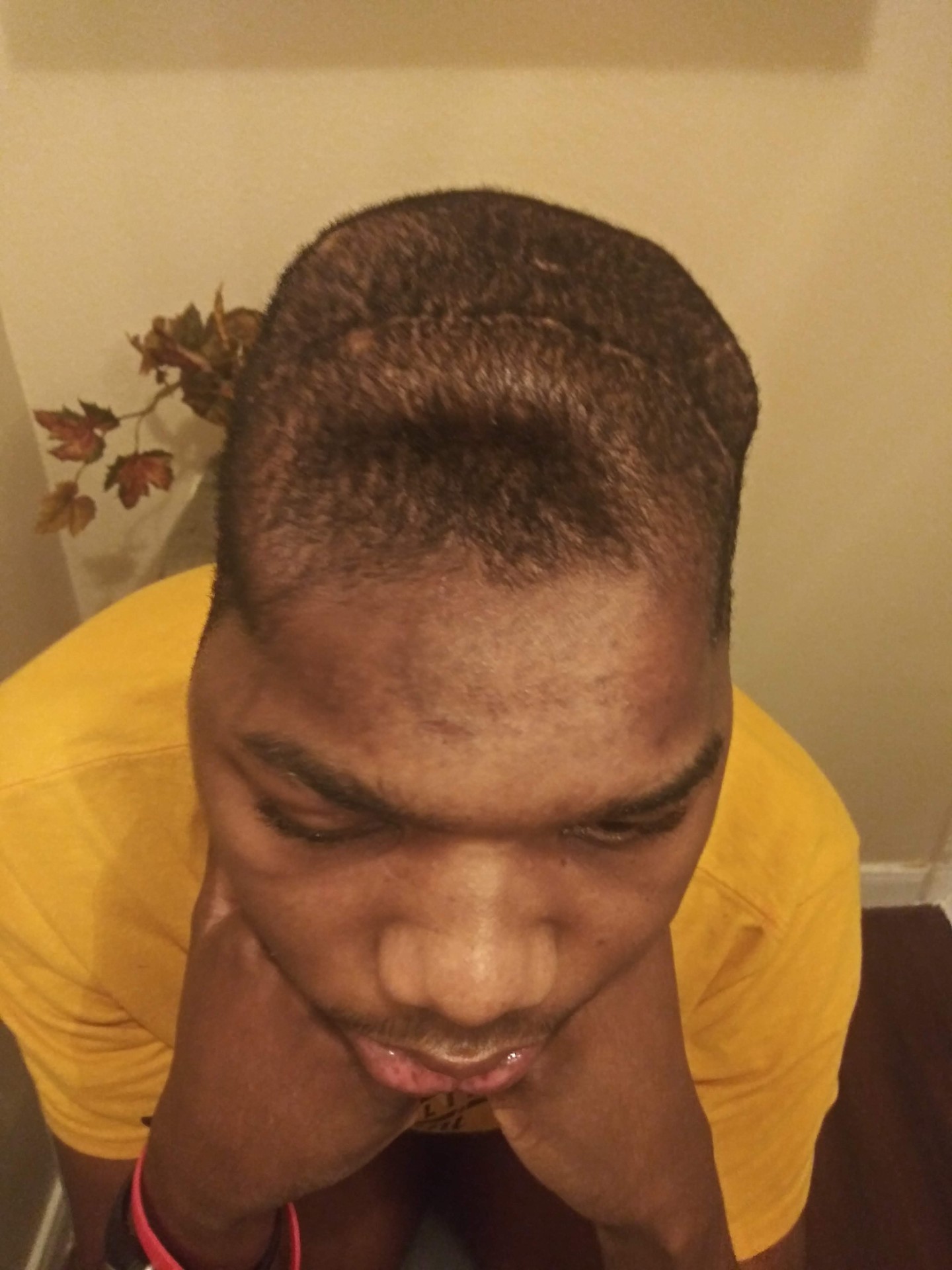 Surgical scars from craniotomy and skull reconstruction